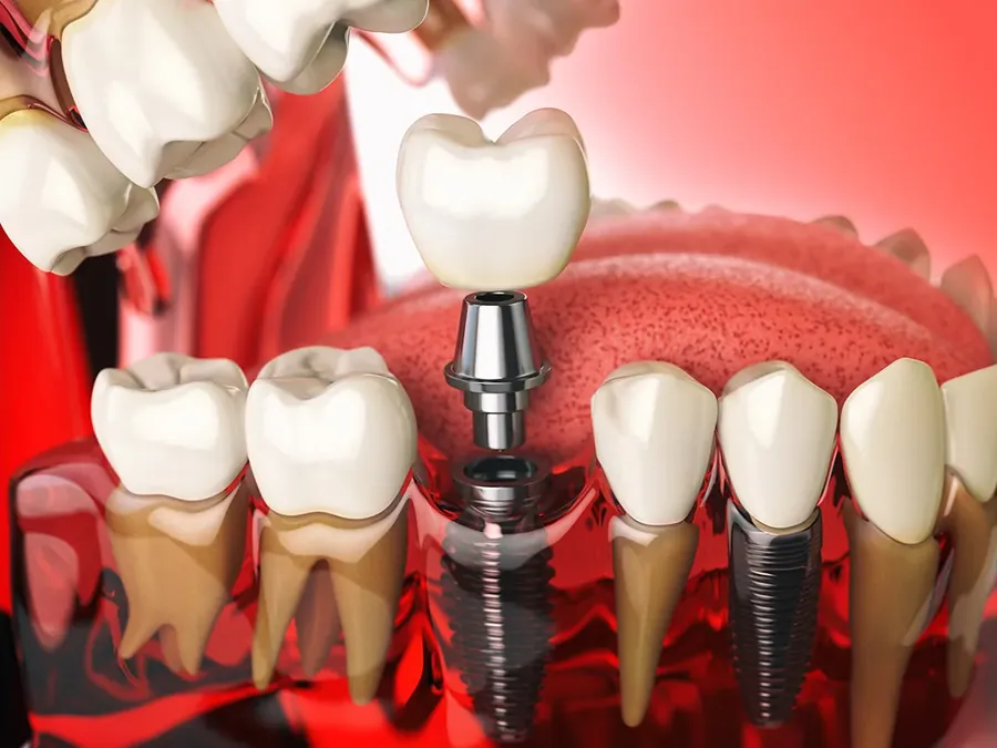 Implantat oder Brücke? Die richtige Wahl