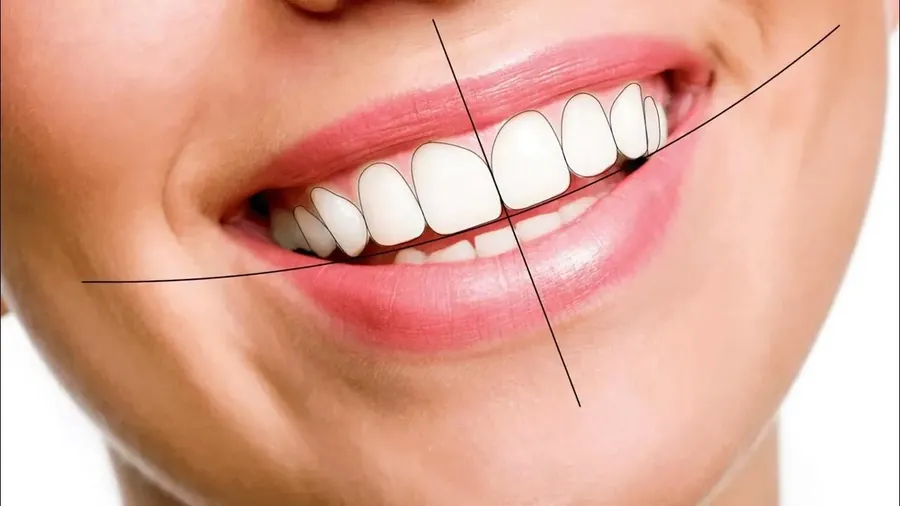 Was ist ein Smile-Design und für wen ist es geeignet?